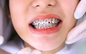 Nữ sinh Trung Quốc suýt không được vào phòng thi vì niềng răng