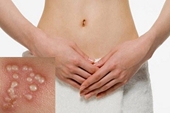 Cách nào phòng ngừa Herpes sinh dục tái phát