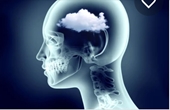 Sương mù não có thể kéo dài ở bệnh nhân Covid-19
