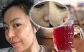 Trị nám tại nhà bằng bài thuốc dân gian đơn giản