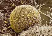 Người phụ nữ hết sạch virus HIV sau khi cấy ghép tế bào gốc
