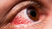 Virus gây xuất huyết ở mắt lan đến châu Âu, tỷ lệ tử vong đến 40
