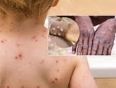 CDC Mỹ phối hợp với Bộ Y tế Việt Nam để phòng bệnh đậu mùa khỉ
