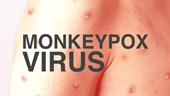 Bệnh đậu mùa khỉ không chỉ liên quan đến quan hệ tình dục đồng giới