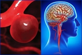 Phình mạch máu Dấu hiệu nhận biết và những nguy cơ cho sức khoẻ