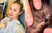 Cô gái 29 tuổi phát hiện mắc ung thư từ 1 nốt ruồi trên đỉnh đầu