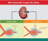 Tổn thương thận do đái tháo đường khi nào đáng lo