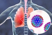 Biện pháp hỗ trợ giảm triệu chứng viêm phổi khi trời trở lạnh tại nhà
