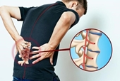 Dùng thuốc chữa đau lưng do viêm cột sống dính khớp ở người trẻ