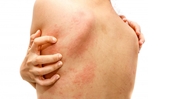 Nguyên nhân gây phát ban đỏ trên da và cách khắc phục