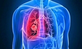 Thuốc trị ung thư, triển vọng trong điều trị xơ phổi vô căn