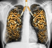Điểm mặt các yếu tố làm tăng nguy cơ ung thư phổi