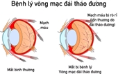 Những bệnh lý về mắt ở người bệnh đái tháo đường