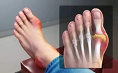 Sưng đau khớp ngón chân cái là bệnh gì, có nguy hiểm không