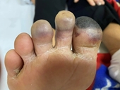 Khi lạnh cảnh giác với hội chứng Raynaud khiến ngón tay, chân xanh tím và đau buốt
