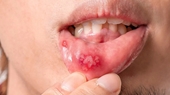 4 bất thường lặp lại ở miệng cho thấy gan đã bị tổn thương