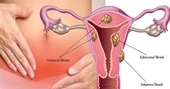 U xơ tử cung khi mang thai có ảnh hưởng đến thai nhi không