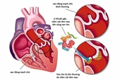 Ngăn ngừa biến chứng viêm nội tâm mạc nhiễm khuẩn