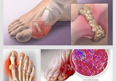 Bệnh gout Nguyên nhân, phân loại và cách điều trị