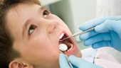 Cách xử trí khi trẻ bị chảy máu chân răng