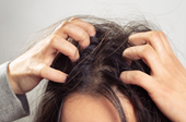Căn bệnh có thể gây rụng tóc vĩnh viễn