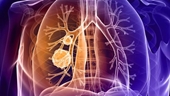 Những triệu chứng bất thường cảnh báo ung thư phổi