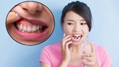 Viêm quanh răng Nguyên nhân, biểu hiện và điều trị
