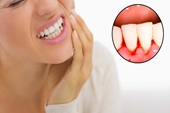 Viêm quanh răng mạn tính và cách chữa