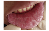 Nhiễm HPV trong miệng có biểu hiện gì