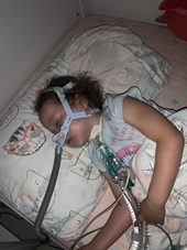 Bé gái 6 tuổi hằng đêm phải thở máy bởi bệnh “quên thở”