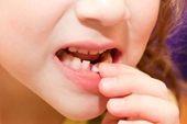 Chấn thương răng sữa ở trẻ xử trí thế nào