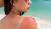5 cách bảo vệ da và chữa cháy nắng