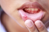 6 sai lầm khi trị nhiệt miệng khiến bệnh lâu khỏi