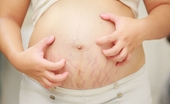 Những vấn đề về da có thể gặp phải khi mang thai