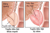 Món ăn bài thuốc hỗ trợ trị viêm tuyến tiền liệt