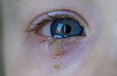 Đau mắt đỏ ở trẻ nhỏ gia tăng Khi nào cần thăm khám bác sĩ