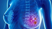 Bệnh nhân ung thư vú giai đoạn đầu đều sống lâu, yếu tố làm tăng nguy cơ tử vong ở người bệnh