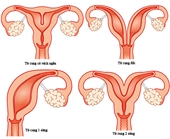 Bất thường ở tử cung ảnh hưởng đến khả năng sinh sản thế nào