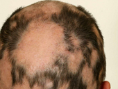 Thêm liệu pháp trị rụng tóc từng mảng cho người lớn và thanh thiếu niên
