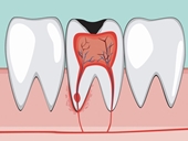Những biến chứng nguy hiểm của viêm tủy răng