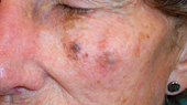 Cẩn thận với những điểm bất thường trên gương mặt có thể là dấu hiệu ung thư da