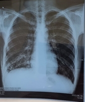 Viêm phổi do Mycoplasma Dấu hiệu và cách phòng ngừa