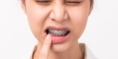 Hệ lụy của niềng răng sai cách và cách khắc phục