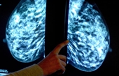 Các nhà khoa học Mỹ phát triển thuốc trị ung thư có thể tiêu giảm khối u
