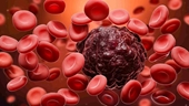 Ung thư máu Nguyên nhân, dấu hiệu và cách điều trị