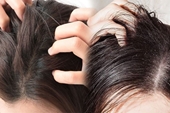 Điều trị dứt điểm ngứa da đầu bằng biện pháp tự nhiên tại nhà