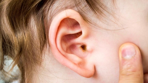 4 lưu ý để phòng tránh thủng màng nhĩ khi lấy ráy tai cho trẻ