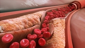 Khi “vòng 3” xuất hiện biểu hiện này, coi chừng cholesterol tăng vọt, phát hiện sớm sẽ ít bệnh
