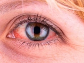 Vì sao nên ngủ riêng, cách ly tương đối khi đau mắt đỏ