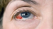 Đột quỵ mắt là gì Dấu hiệu, nguyên nhân và cách phòng ngừa